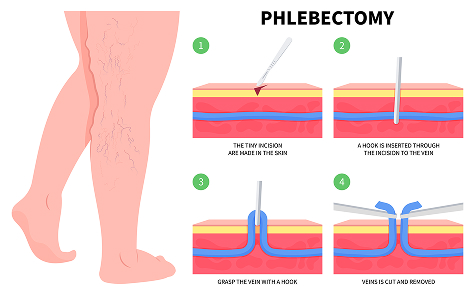 How microphlebectomy works