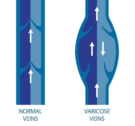 What Causes CVI?