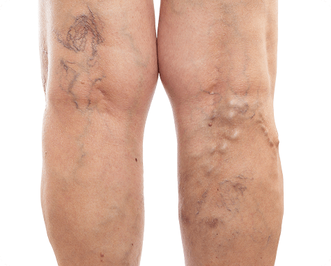 What Conditions Can RFA Treat?