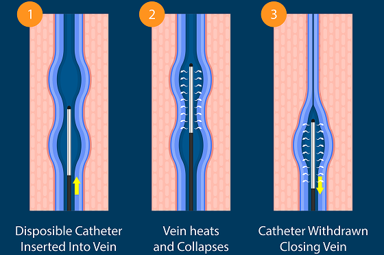 What Is Radiofrequency Ablation?