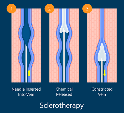 What Is Sclerotherapy?